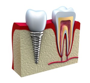 Имплантация зубов - это больно?
