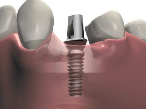 Имплантация зубов: показания, процедура, стоимость