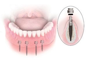 Имплантация нижних зубов