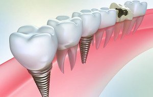 Какие зубные импланты лучше?