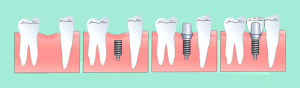 Этапы зубной имплантации