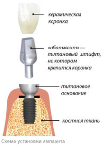 Сколько стоит имплантация зубов?