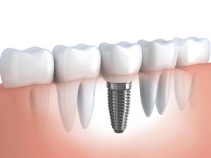Имплантация зубов. Общая статья.
