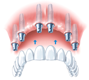 Как появилась имплантация зубов?