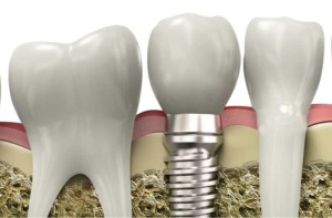 Как происходит процесс имплантации зубов?