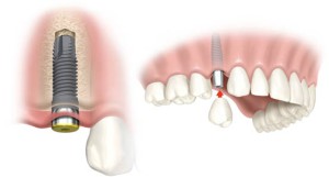 Имплантология в стоматологии