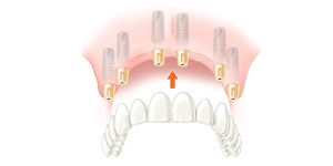 Несъемный протез на имплантах