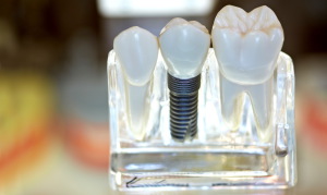 Протезирование на зубных имплантах