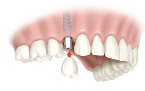 Как соединяются зубной протез и абатмент?
