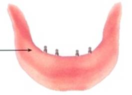 Имплантация зубов при значительной атрофии верхней челюсти
