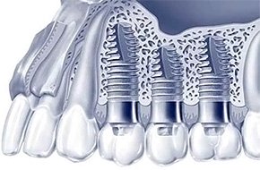 Все преимущества дентальной имплантации зубов