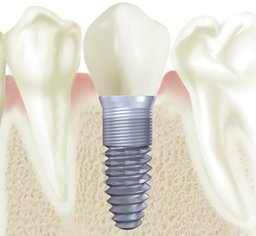 Сроки службы зубного импланта
