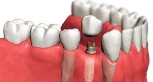 Имплантация или протезирование зубов?
