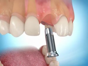 Имплантация зубов и требование к кабинету