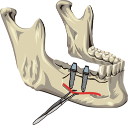 Имплантация при значительной атрофии нижней челюсти