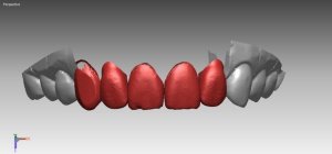 Компьютерное моделирование в зубной имплантации