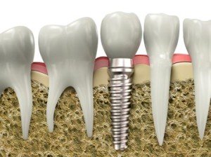 Одномоментная имплантация зубов сразу после удаления