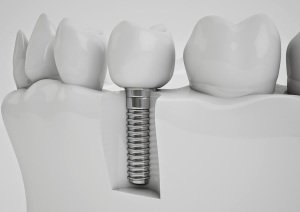 Современное представление об имплантации зубов