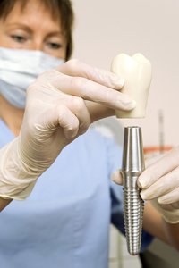 Плюсы имплантов перед несъемным протезированием зубов