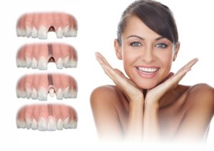 Ортопедический этап лечения (после имплантации зубов)