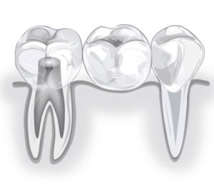Восстановление утраченных зубов и жевательной эффективности